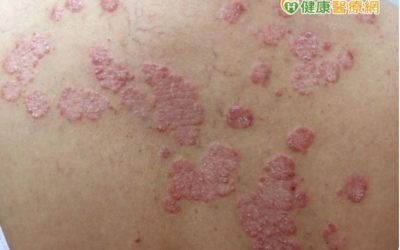 頭皮屑洗不完？臉紅如酒醉？醫師治療乾癬有一套