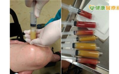 膝蓋痛打一針就好？　錯誤觀念恐害你得不償失